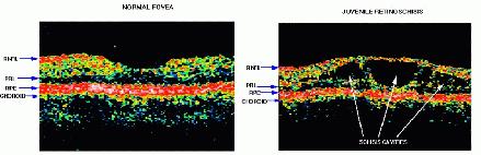 ocular imaging of RS