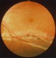 photograph of an RS-affected retina